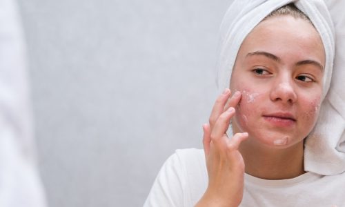 Tratamiento del Acné en Alergomed