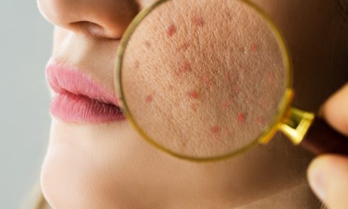 Importancia del Tratamiento Temprano Tratamiento del Acné en Alergomed