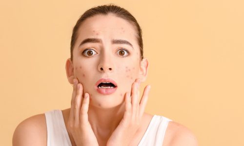 Prevenir Cicatrices y Manejar el Acné a Largo Plazo​